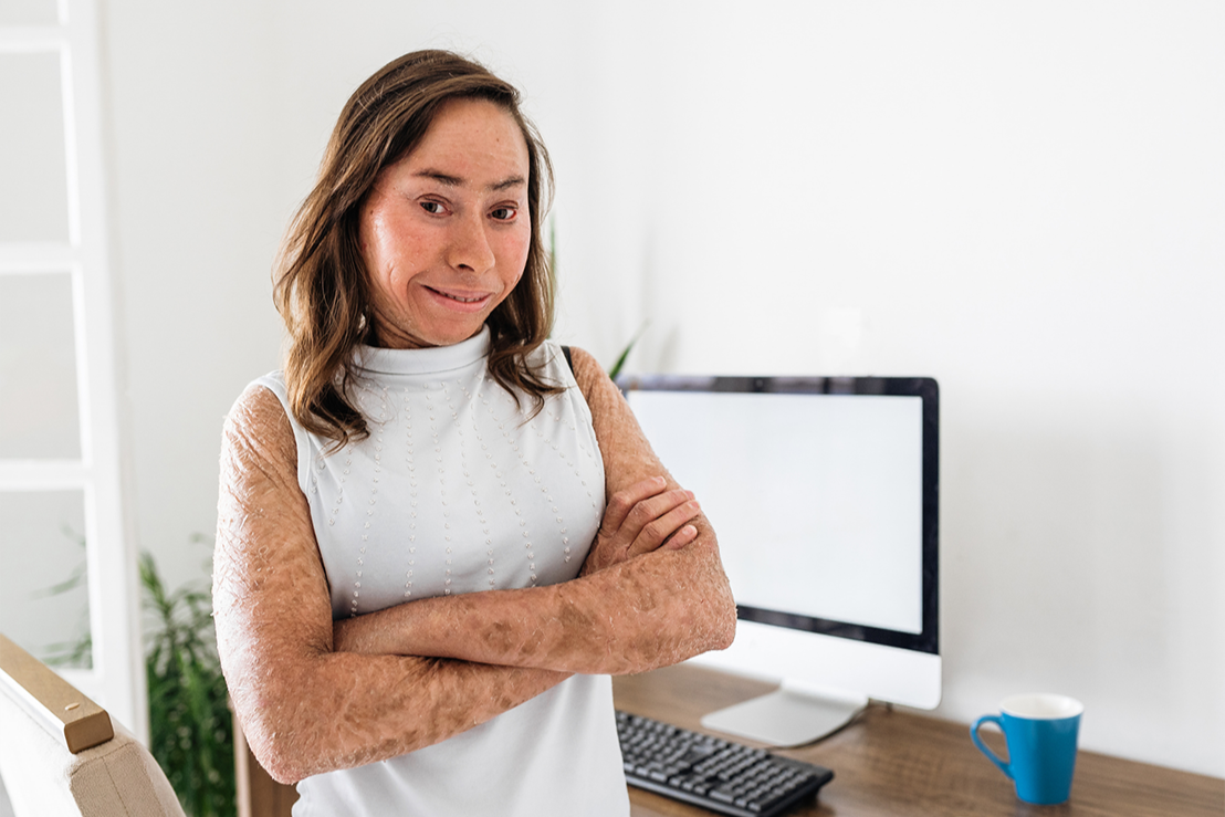 Ichthyosis Support Hub